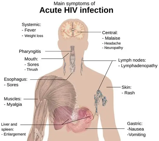 Communicable diseases list-HIV infection-