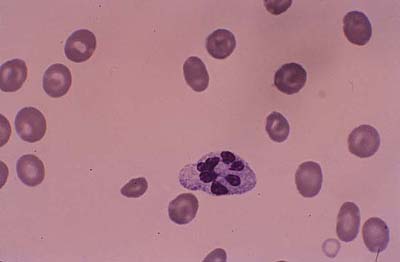 Types of Anemia