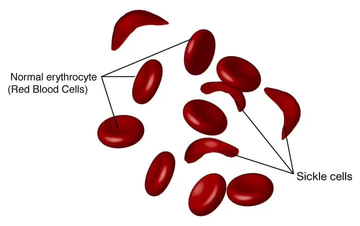 Types of anemia-sickle anemia