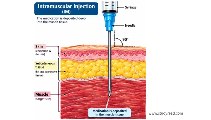 Intramuscular Injection diagram